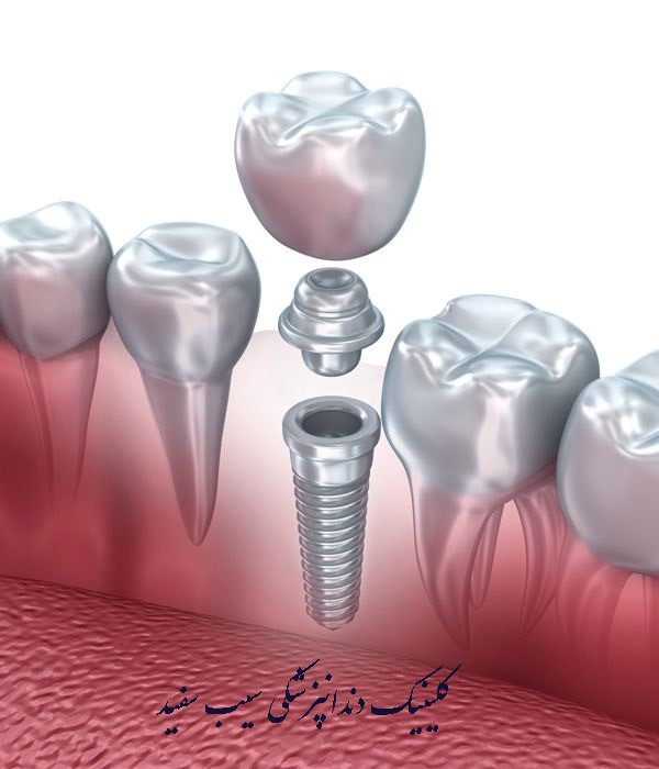 تفاوت ایمپلنت دندان و تاج دندان