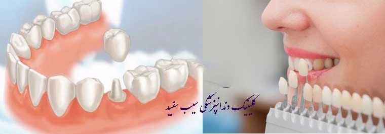 تفاوت ایمپلنت دندان و لمینت دندان