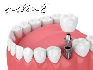 naresaei-implant-dandan