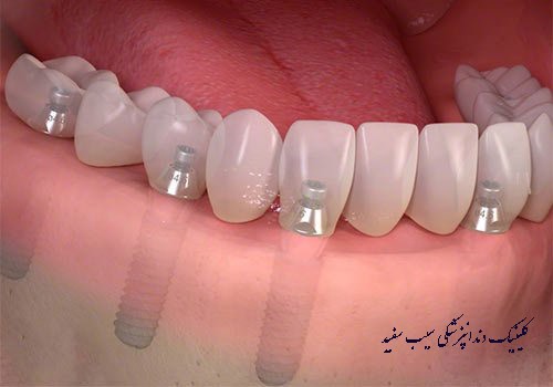 implant-kole-dahan