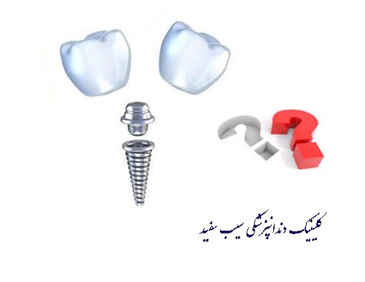 یک ایمپلنت دندان، جایگزین چند دندان می شود