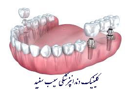 yek-implant-dandan-jaygozine-chand-dandan-mishavad