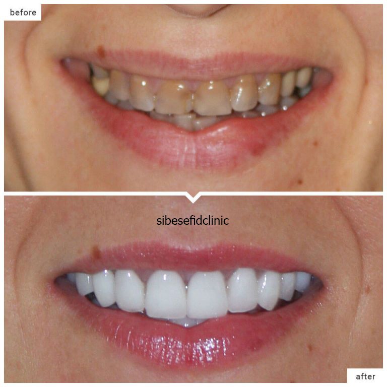 برداشتن کامپوزیت