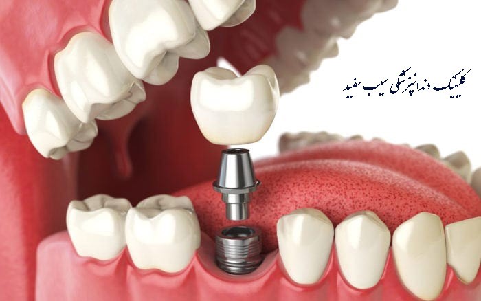 life-span-of-dental-implants