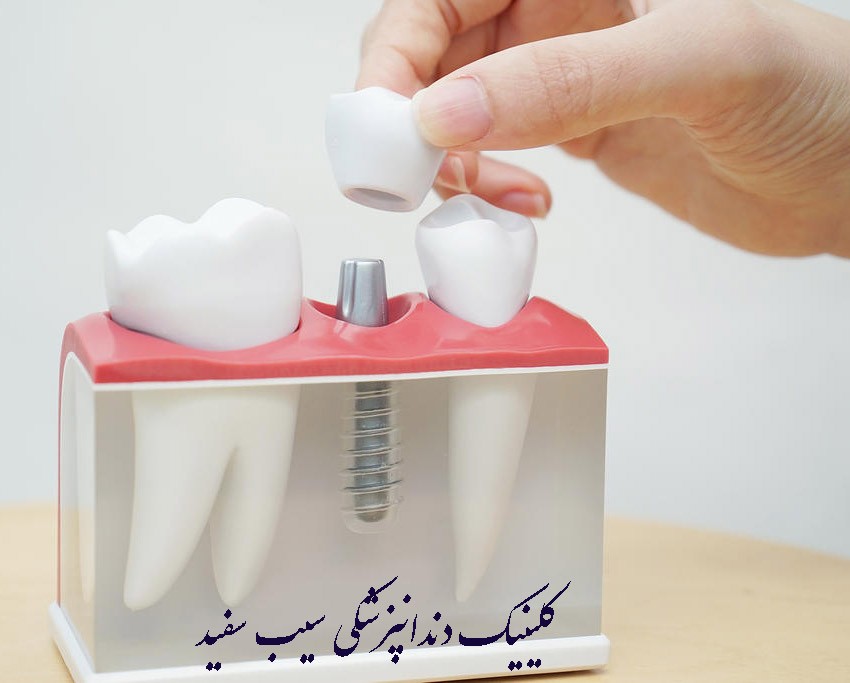 ایمپلنت دندان از چه چیزی ساخته شده است