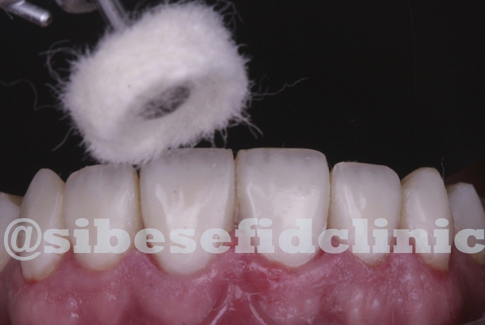 آیا بیرون زدگی فک را می توان با درمانهای کامپوزیت ونیر اصلاح کرد؟