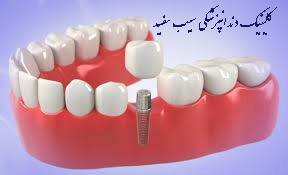 ایمپلنت دندان چیست