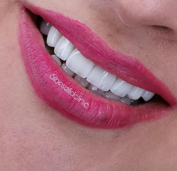 انتخاب نوع و رنگ مناسب لمینت سرامیکی