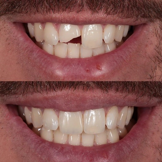 مزایای کامپوزیت ونیر و طول عمر آن