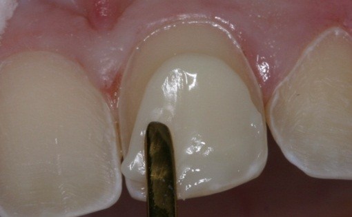 شفافیت در کامپوزیت ونیر