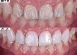 کامپوزیت ونیر چیست؟همه چیز درباره کامپوزیت ونیر دندان