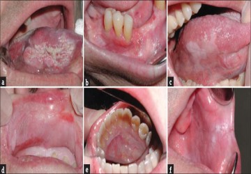 بیماری لوکوپلاکیا (Leukoplakia) چیست؟
