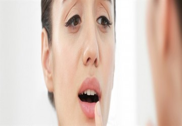 سندرم سوزش دهان