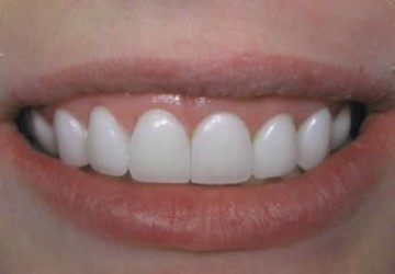 چگونه ونیر های دندان در طول زمان تغییر یافته اند؟