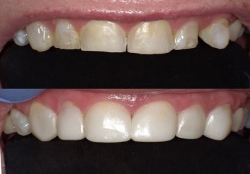 جایگزینی برای لمینت و کامپوزیت دندان- بایوکلیر(Bioclear)