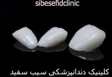 تفاوت لمینت دندان و لومینیرز