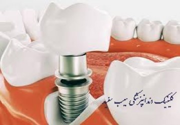 سوالات متداول درباره ی ایمپلنت دندان