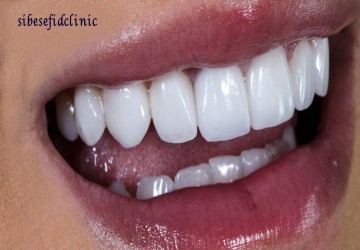 آیا می توان لمینت دندان را دوباره سفید کرد