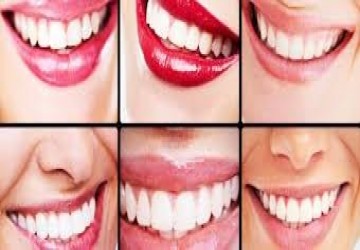 بهترین رنگ و شکل لمینت دندان