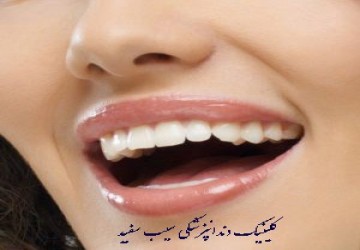 تغییر رنگ لمینت دندان