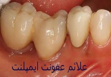 علائم عفونت ایمپلنت دندان