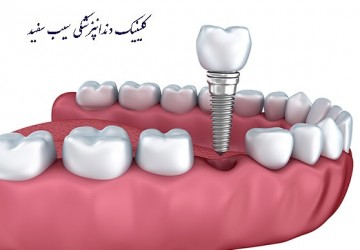 نارسائی ایمپلنت دندان