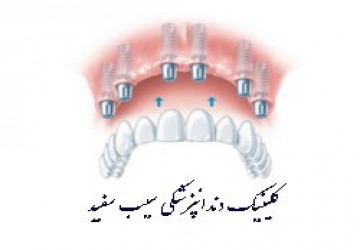 ایمپلنت کل دهان