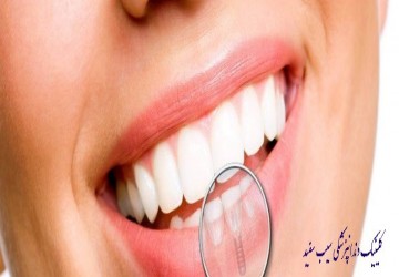 ایمپلنت فوری دندان/ کاشت دندان در یک روز