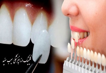 آیا لمینت دندان سبب پوسیدگی دندان می شود