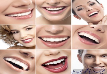 چه تعداد از دندان ها باید کامپوزیت شوند