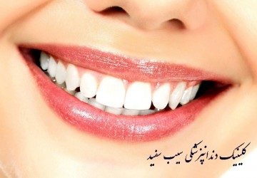 مزایای لمینت دندان