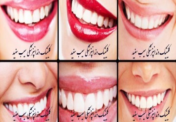 تفاوت انواع لمینت دندان