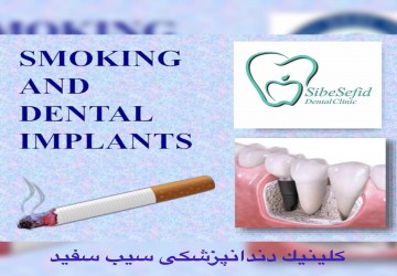 تاثیر سیگار بر ایمپلنت یا کاشت دندان