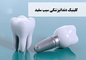 انجام ایمپلنت دندان چقدر زمان میبرد؟