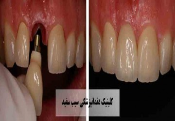 افتادن و شل شدن ایمپلنت دندان