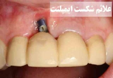 علائم پس زدن و شکست ایمپلنت دندان