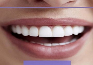 انتخاب رنگ کامپوزیت ونیر بر چه مبنایی است؟