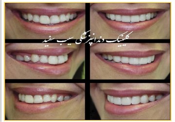 راز طبیعی بنظر رسیدن کامپوزیت ونیر چیست؟