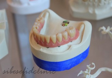 ایمپلنت بهتر است یا بریج دندان