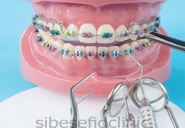 آیا ارتودنسی محدودیت سنی دارد؟