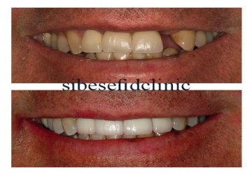 آیا انجام ایمپلنت محدودیت سنی دارد؟