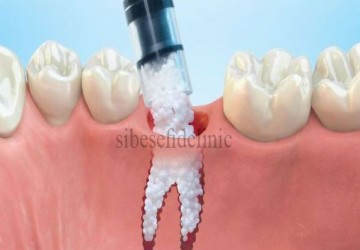 مراقبت وعوارض پیوند استخوان ایمپلنت