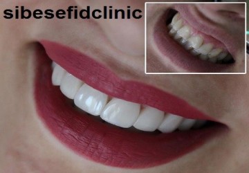 بهترین برند برای انجام کار کامپوزیت دندان