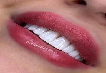 آیا کامپوزیت ونیر برای دندانها مشکل ایجاد میکند؟