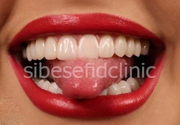 نکاتی که قبل از لمینت باید بدانید