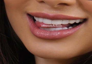 چند نكته  در مورد انتخاب رنگ كامپوزيت