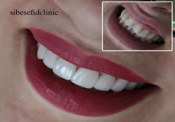 کامپوزیت ونیر چه میزان تراش لازم دارد؟