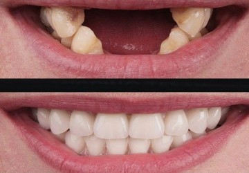 مراقبت های بعد از انجام ایمپلنت دندان