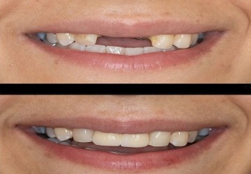 جراحی سینوس برای کاشت ایمپلنت دندان