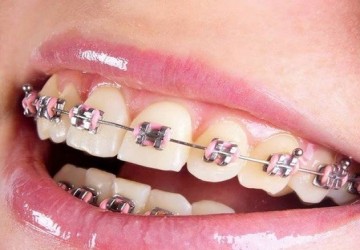 سن مناسب برای ارتودنسی دندان